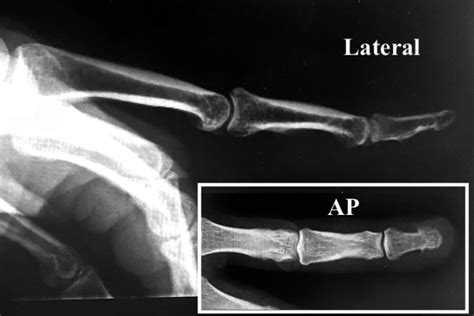 Melanoma Hand Surgery Source