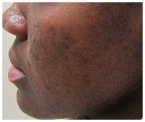 Types Of Pigmentation And Treatment Skinsmart Dermatologist