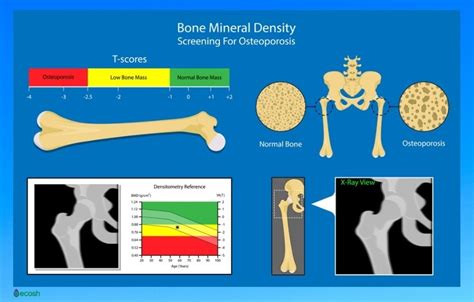 Osteoporosis Symptoms Causes Risk Groups Prevention And Treatment