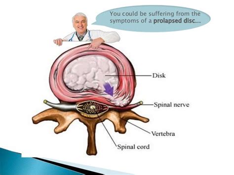 Cause Symptoms And Treatments For Prolapsed Disc