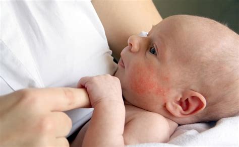 Dermatite Atopica Nei Bambini Sintomi E Rimedi Sanifutura