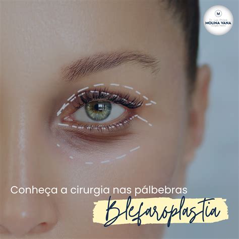 Conheça A Blefaroplastia Cirurgia Nas Pálpebras Dr Molina