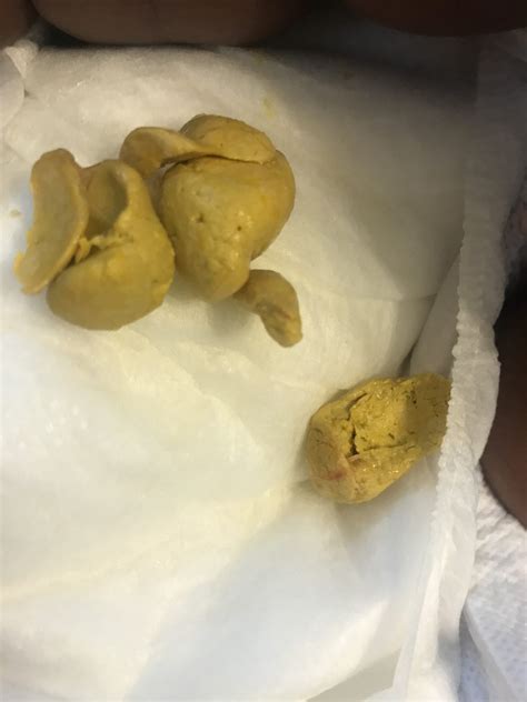 What Does Constipated Baby Poop Look Like Ellie Matthews Blog