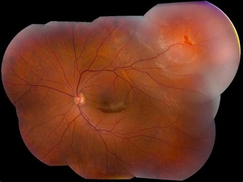Retinal Detachment With Horseshoe Tear Retina Image Bank