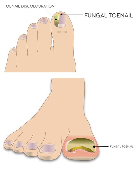 What Causes Thick Black Toenails Nail Ftempo