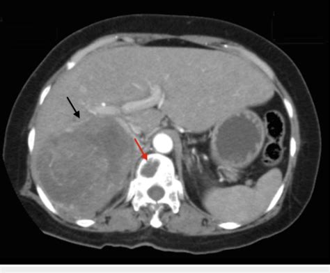 Axial Section At The Level Of T12 From The Ct Scan Of The Patient