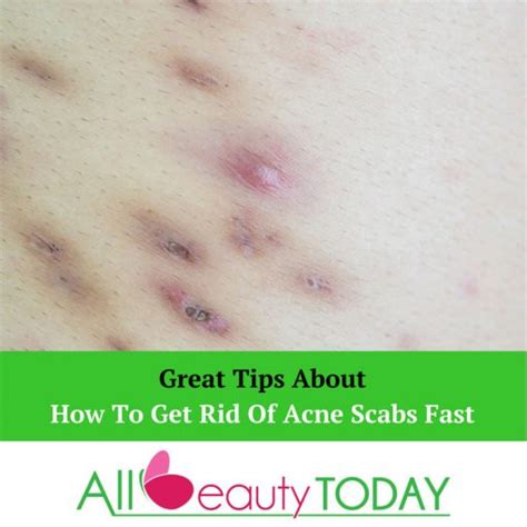 How To Get Rid Of Acne Scabs Fast 3 Method For You