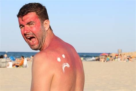 home remedies for sunburn