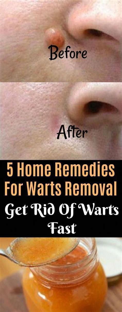 Five Straightforward Residence Treatments To Get Rid Of Skin Warts