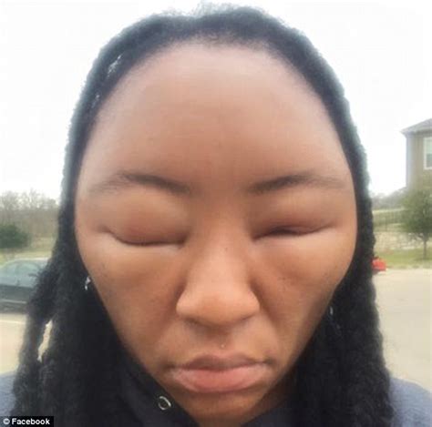 Chemese Armstrong Shares Photos After Allergic Reaction To Henna Hair Dye Daily Mail Online