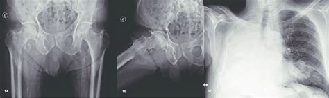 A Anteroposterior Radiograph Of The Pelvis With Avulsion Fracture Of