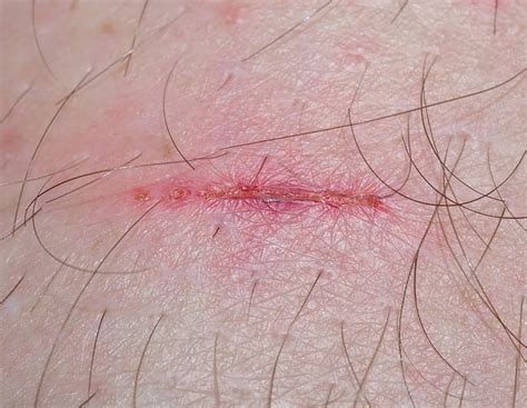 Does A Wound Heal Faster Dry Or Moist Wound Care Society