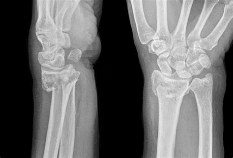 What Is A Distal Radius Fracture Symptoms Causes And Treatments