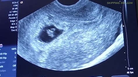 Missed Miscarriage ️ No Heartbeat At 8 Weeks Pregnancy