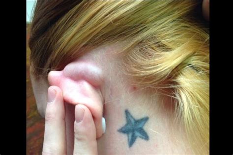 Dermdx Growth Behind The Ear Dermatology Advisor