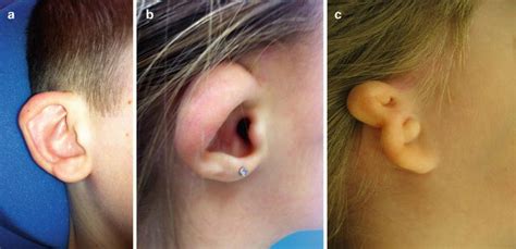 Congenital Malformations Of The Ear Ento Key