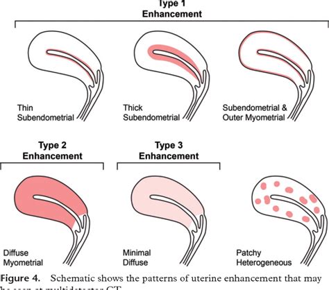 Normal Or Abnormal Demystifying Uterine And Cervical Contrast