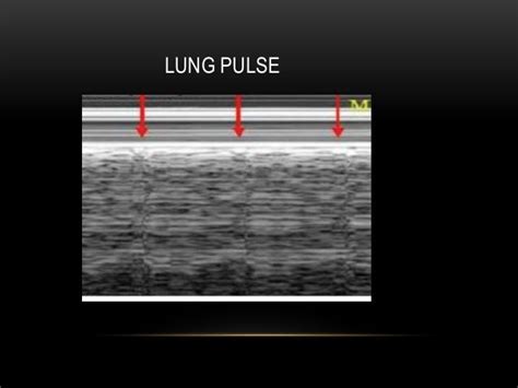 Sonographic Features Of Pneumothorax Dr Suresh