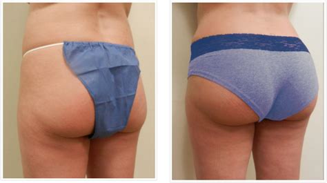 Butt Injections In Boston Butt Lift Surgery With Dermal Fillers