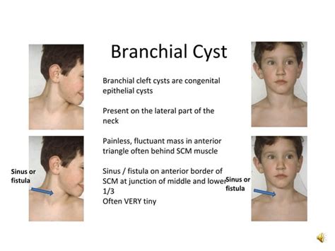 Branchial Remnants And Branchial Cyst Ppt