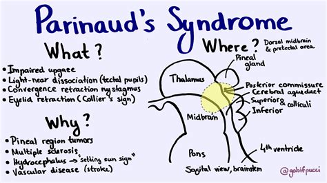 Parinaud Syndrome Pictures