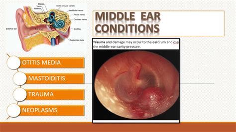 Care Of Patients With Ear And Hearing Disorders Youtube