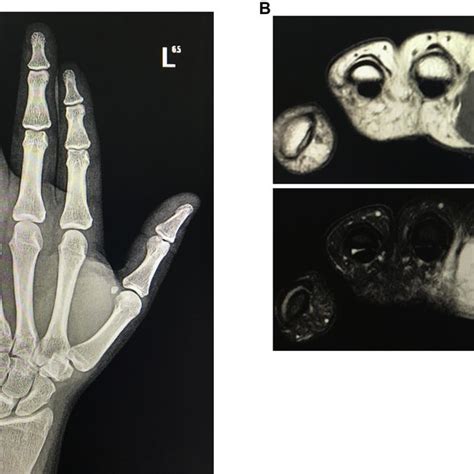 Clinical Presentation Of Digit Fibro Osseous Pseudotumor Mass It Shows
