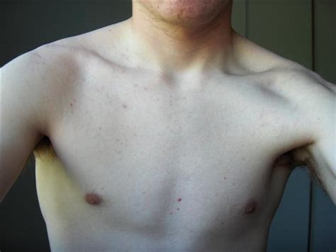 Severe Chest And Bacne Before And After Accutane Show Me Some Love