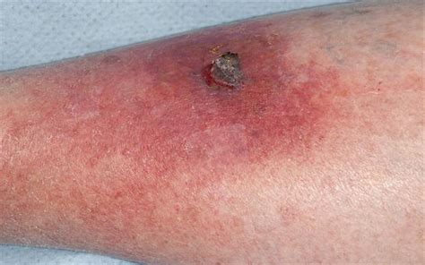 New Cellulitis Treatment Guidance Published Mims Online