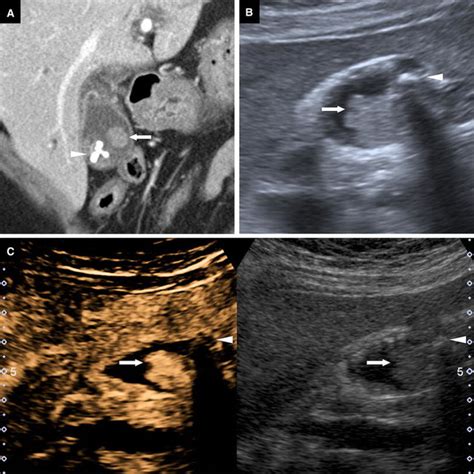 Contrast Enhanced Ultrasound In Gallbladder Disease A Pictorial Review