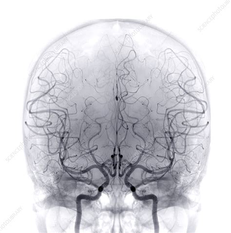 Cerebral Arteries Angiogram Stock Image F0377048 Science Photo