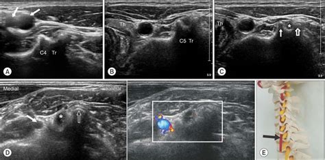 Ultrasound Guided Intervention In Cervical Spine