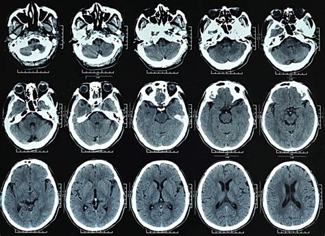 What Is A Cranial Ct Scan Two Views