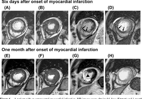 Figure 6 From Cardiac Mri In Ischemic Heart Disease Semantic Scholar