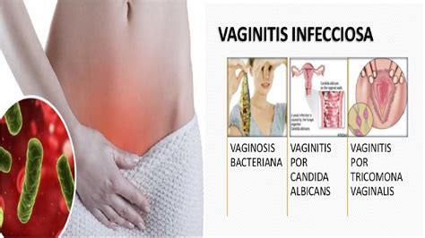 Remedios Y Tratamiento Caseros Para Combatir La Vaginosis Bacteriana