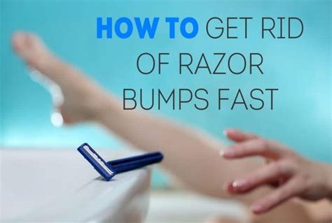 How To Get Rid Of Razor Bumps Top Remedies And Tips Ingrown Hair