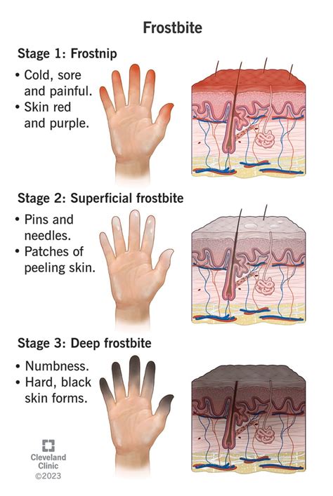 Frostbite Signs And Symptoms Stages Treatment And Prevention