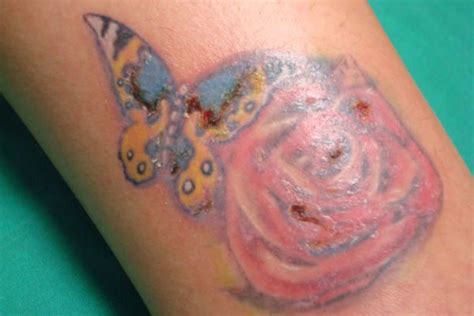 Infecciones Y Reacciones De La Piel Despues De Aplicarse Un Tatuaje