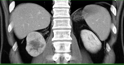 Multiphase Display Of A Renal Cell Carcinoma Kidney Case Studies