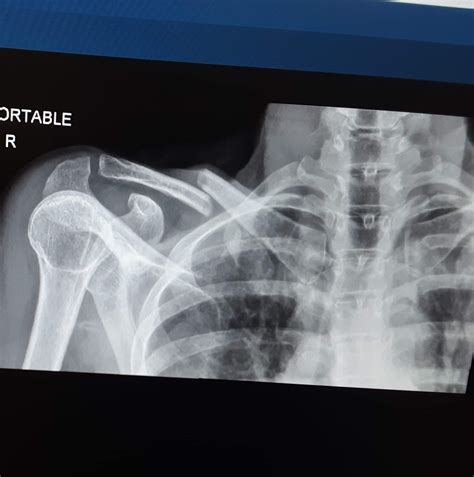 59f Broken Collarbone And Sent Home By Er In A Cast Doctor Said It