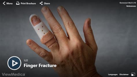 Video Finger Fractures Hughston Clinic