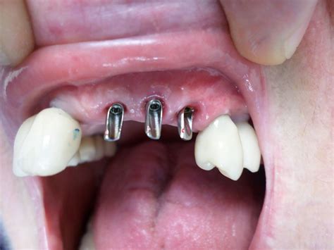 combien d'implants dentaires peut on poser en une seule fois