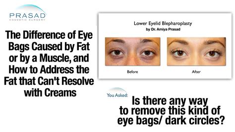 Eye Bags Removal Treatment And What Causes Having Two Kinds Of Eye