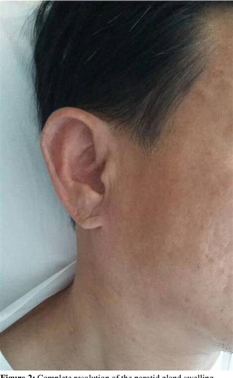 Figure 2 From Transient Unilateral Parotid Gland Swelling Following