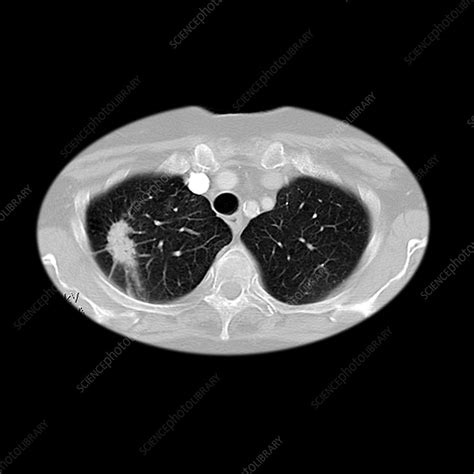 Lung Cancer Stock Image M1340823 Science Photo Library
