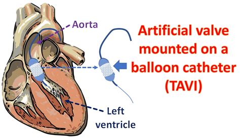 What Is Tavi Cardiology Basics All About Cardiovascular System And