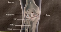 KNEE LIGAMENT INJURY | Klinique Pain Management & Wellbeing Clinic