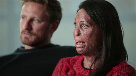 Turia Pitt Burn Survivor And Recipient Of Skin Grafts Youtube