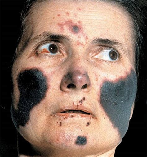 Severe And Life Threatening Skin Eruptions In The Acutely Iii Patient