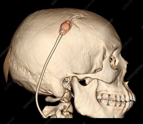 Ct Reconstruction Of Intracranial Shunt Stock Image C0271542